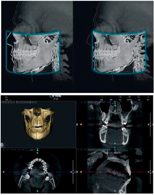 Система рентгеновская с функцией ортопантомографии и конусно-лучевой компьютерной томографии X-MIND RIME ЗD